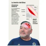 Juicio por la muerte de Maradona: un neurocirujano reveló detalles inéditos de la operación en su cabeza